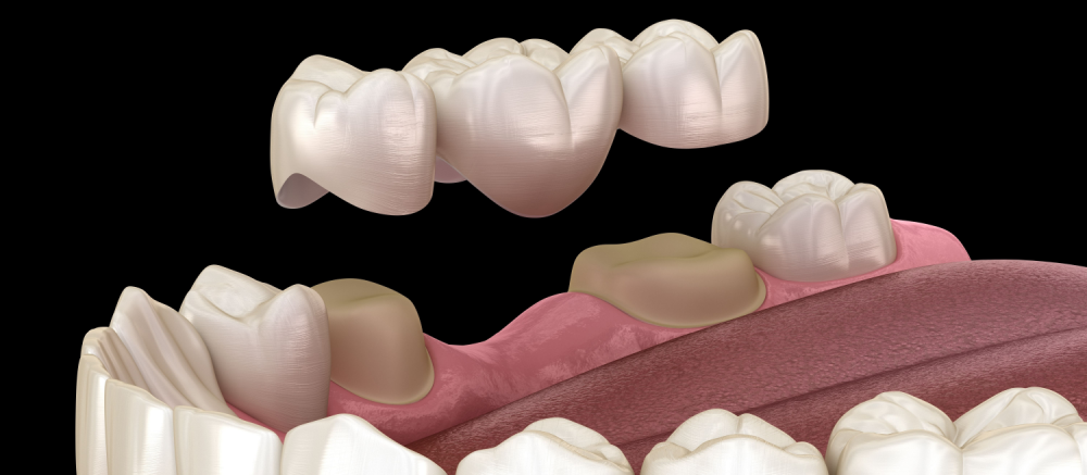 pros and cons of dental bridges