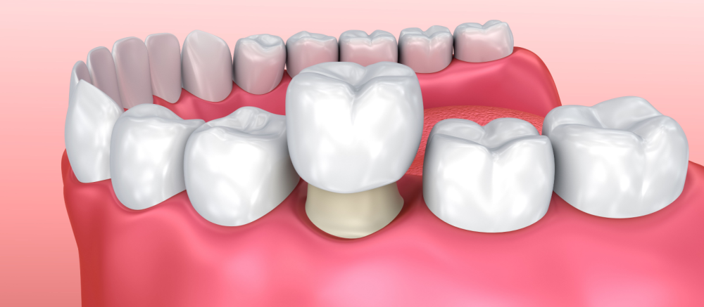 Candidate for a Dental Crown