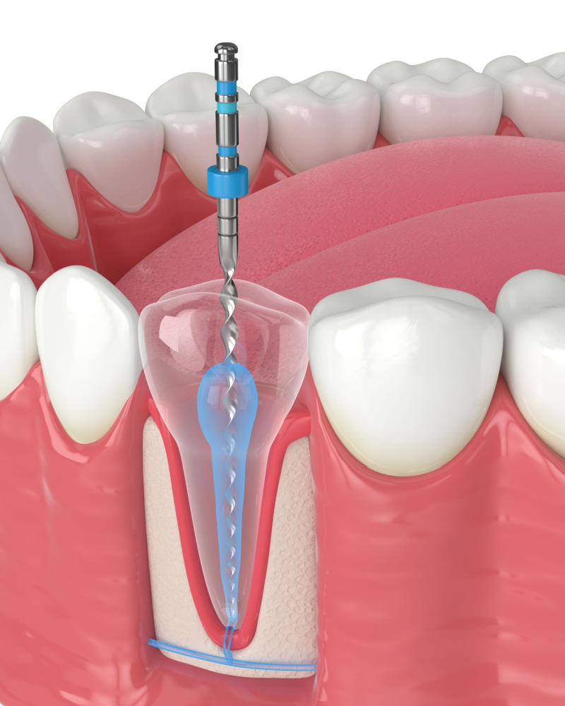 root canal therapy in burke va