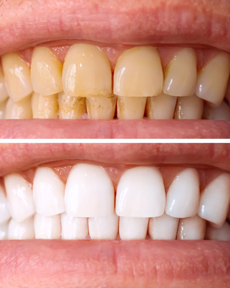 teeth whitening in burke va