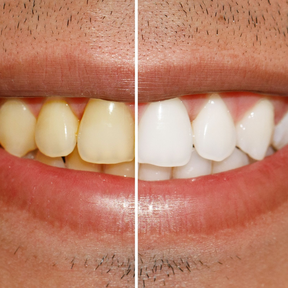 before and after teeth whitening