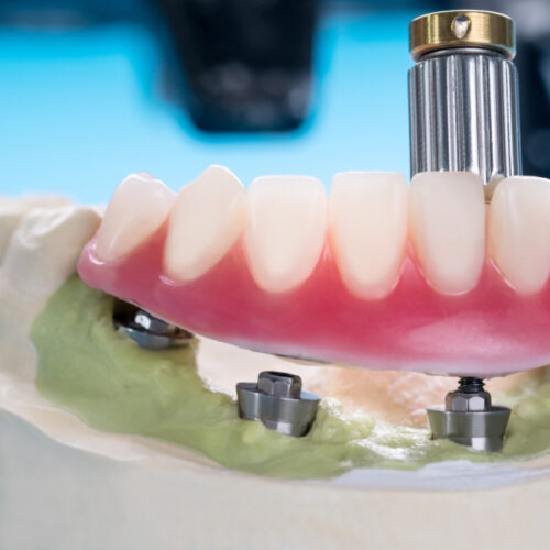 overdentures in burke