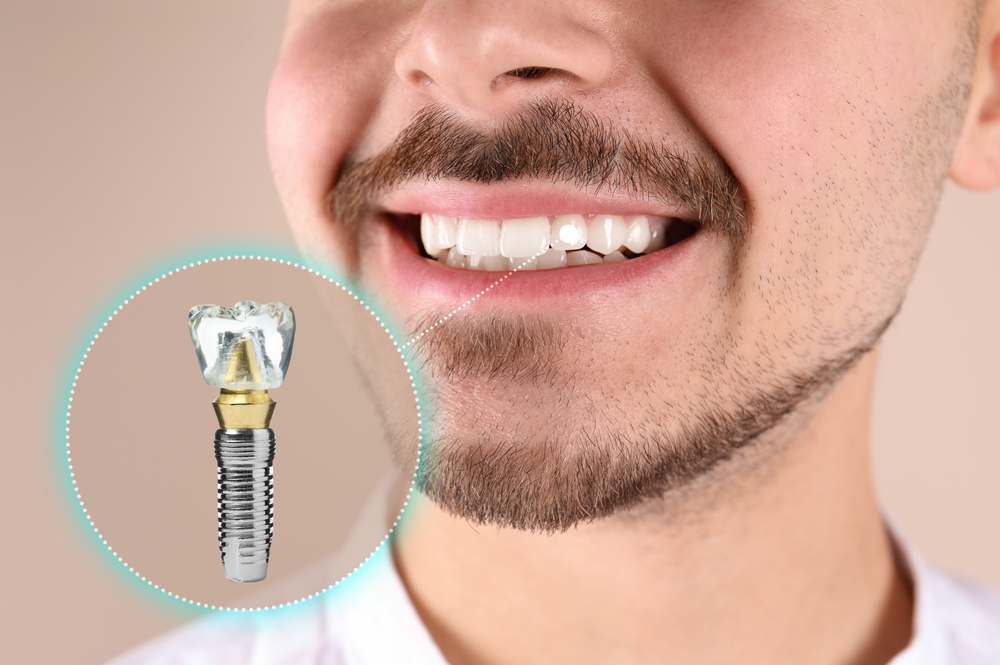 Dental Implant